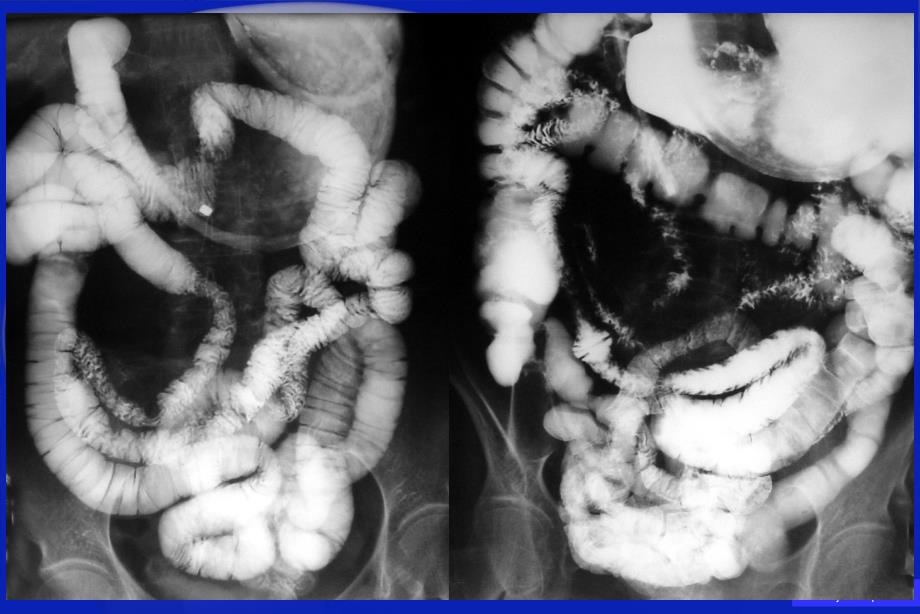 肠道病变的钡剂检查_第3页
