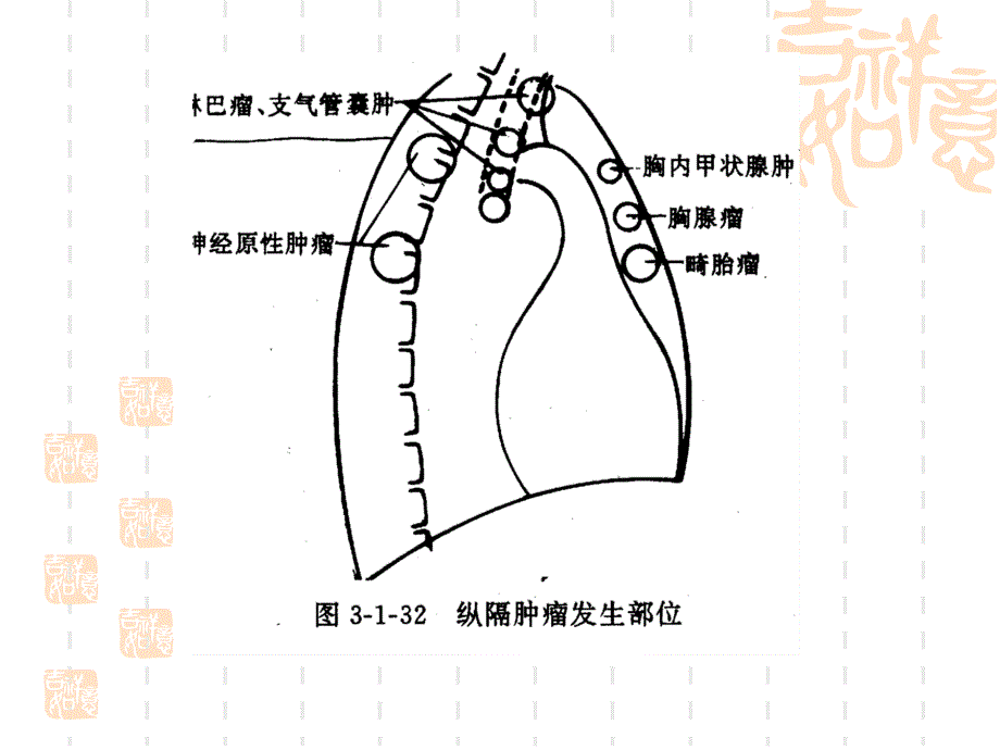 纵隔原发肿瘤讲义.ppt_第1页