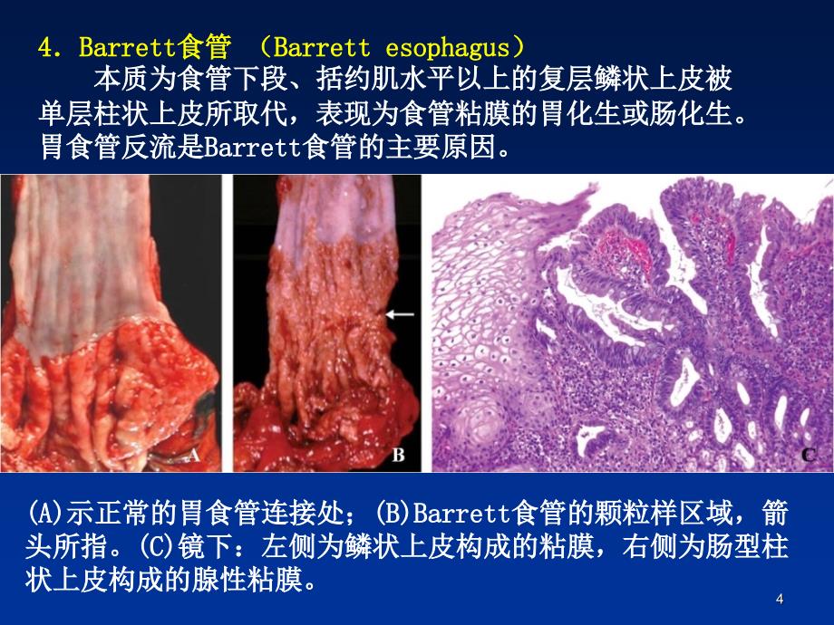 病理系消化食道_第4页