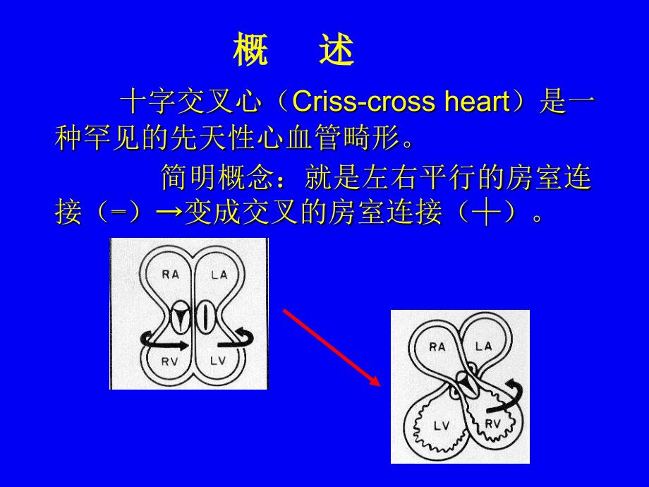 十字交叉心畸形的超声心动图诊断_第2页