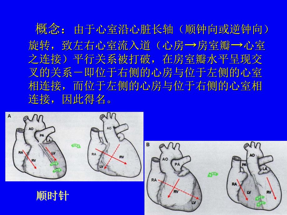 十字交叉心畸形的超声心动图诊断_第3页