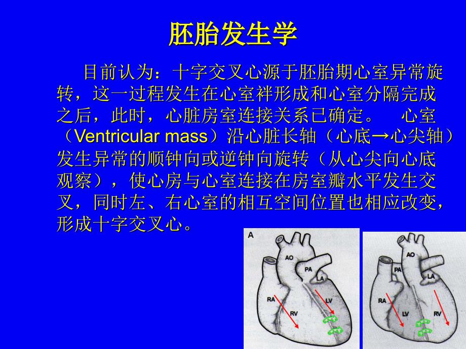 十字交叉心畸形的超声心动图诊断_第4页