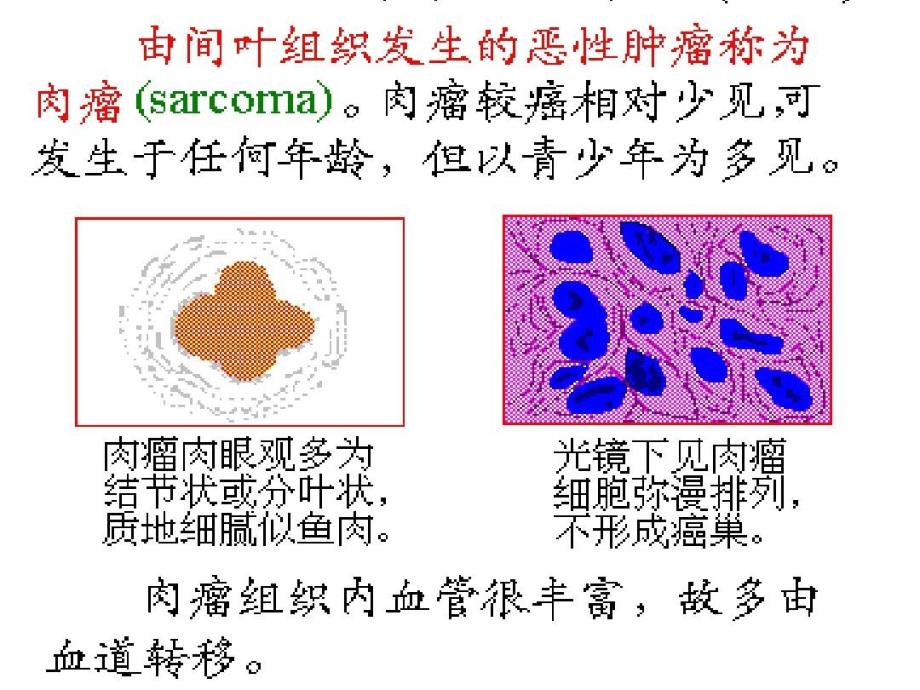 恶性间叶组织肿瘤99页PPT课件_第3页