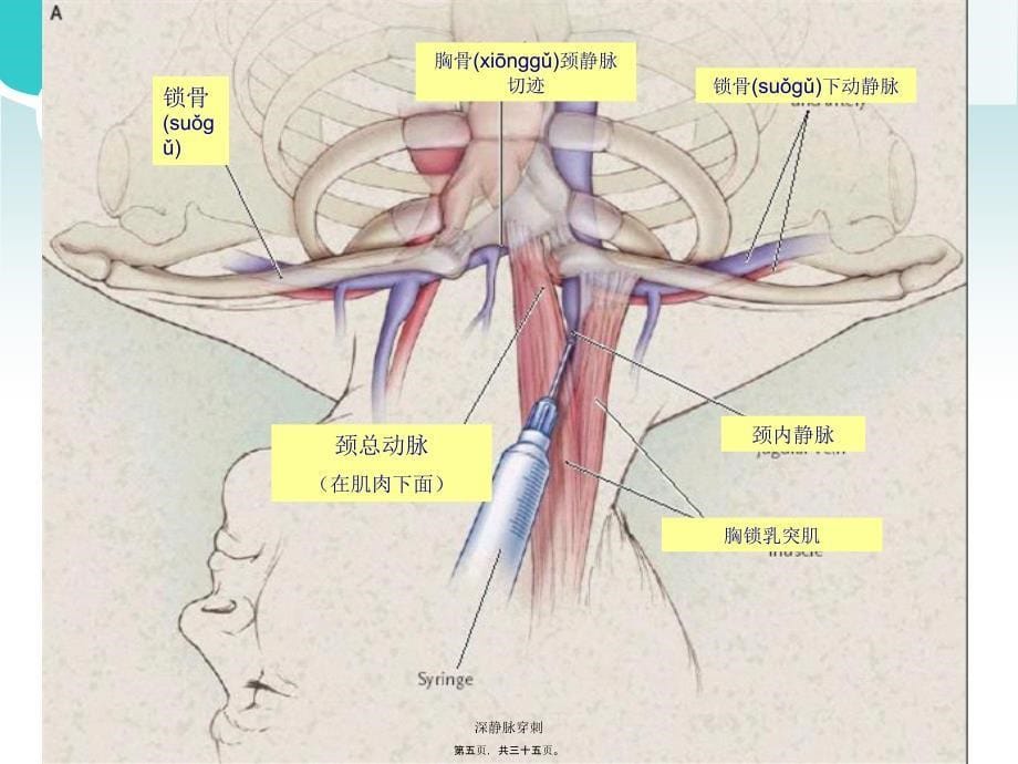 深静脉穿刺课件_第5页