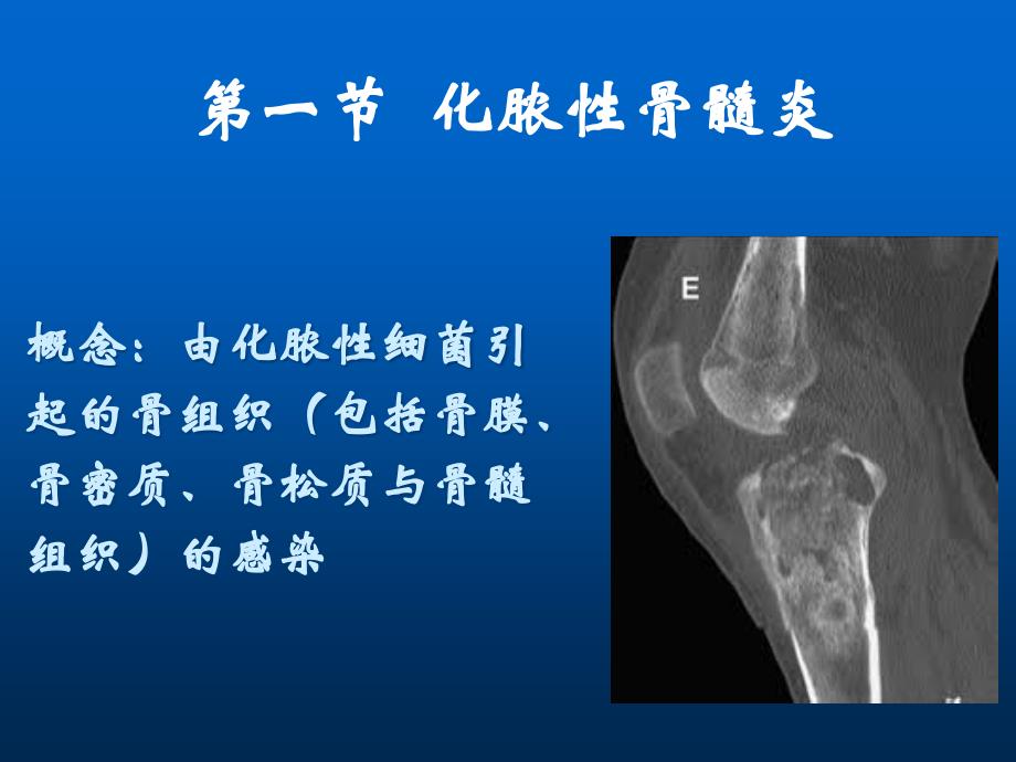 化脓性骨髓炎教学课件_第2页