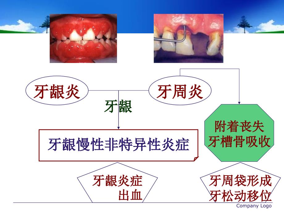 牙周病学牙周病的主要症状和临床病理_第2页