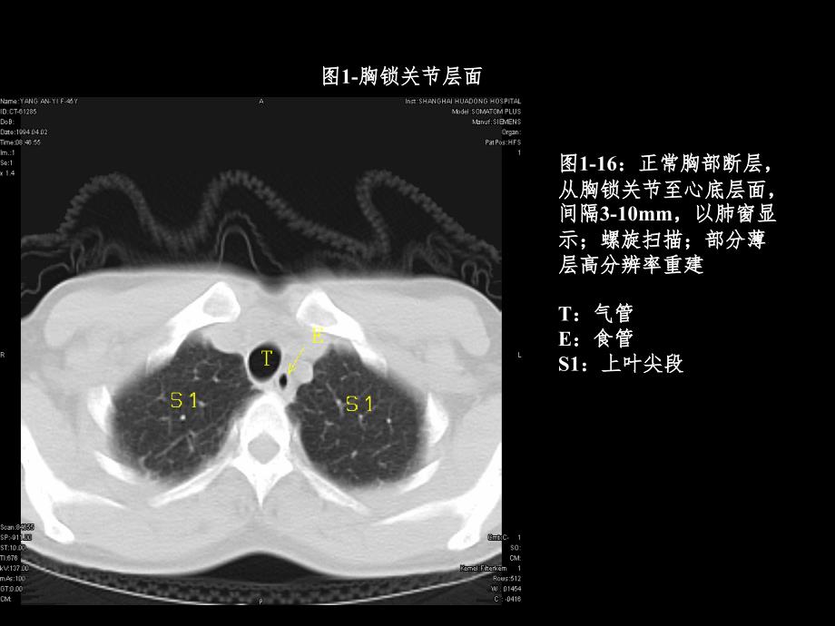 胸部CT3PPT课件_第1页