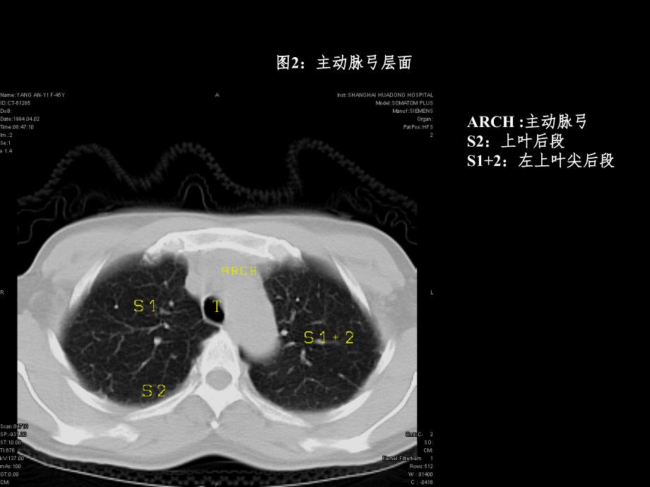 胸部CT3PPT课件_第2页