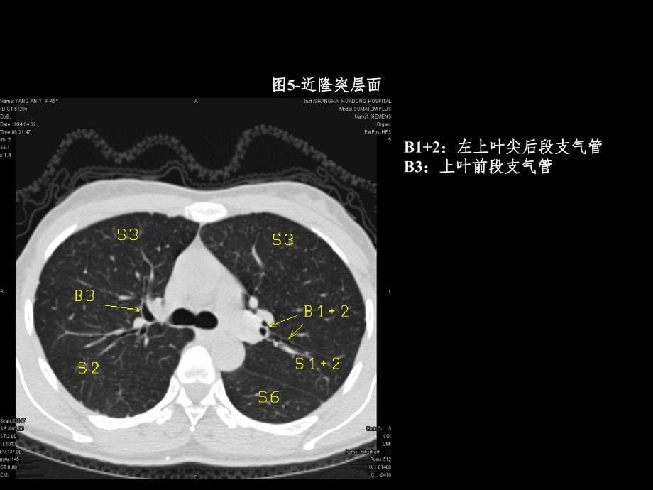 胸部CT3PPT课件_第5页