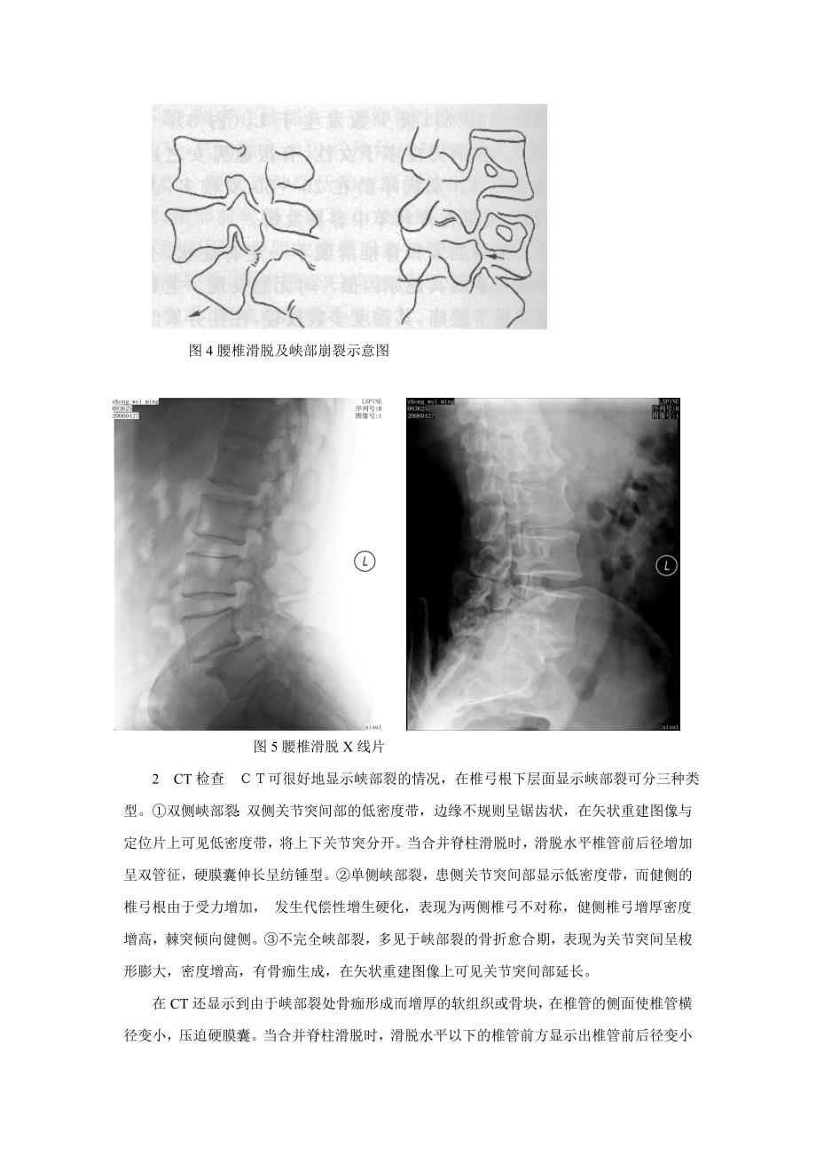 腰椎间盘突出症与腰椎滑脱鉴别_第3页