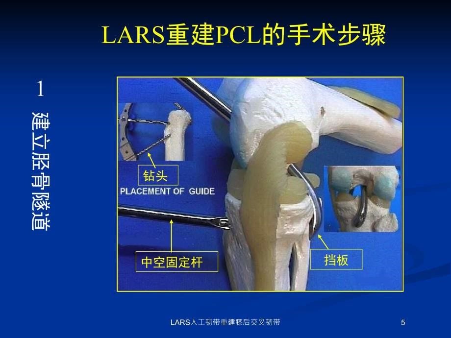 LARS人工韧带重建膝后交叉韧带培训课件_第5页