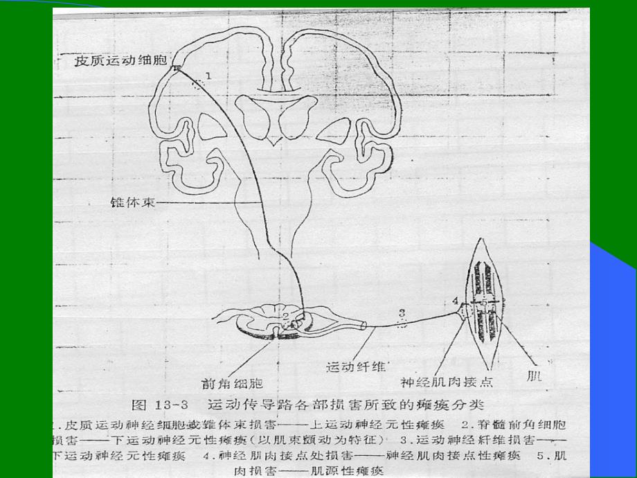 脊髓灰质炎的诊断与鉴别诊断ppt课件_第3页