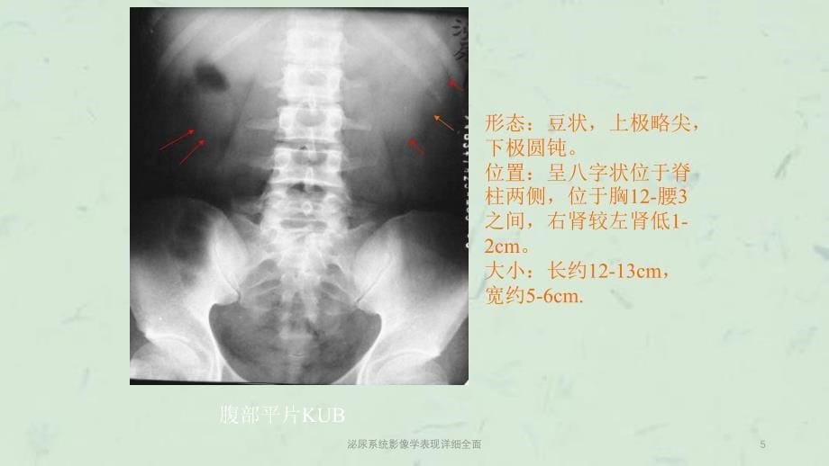 泌尿系统影像学表现详细全面课件_第5页