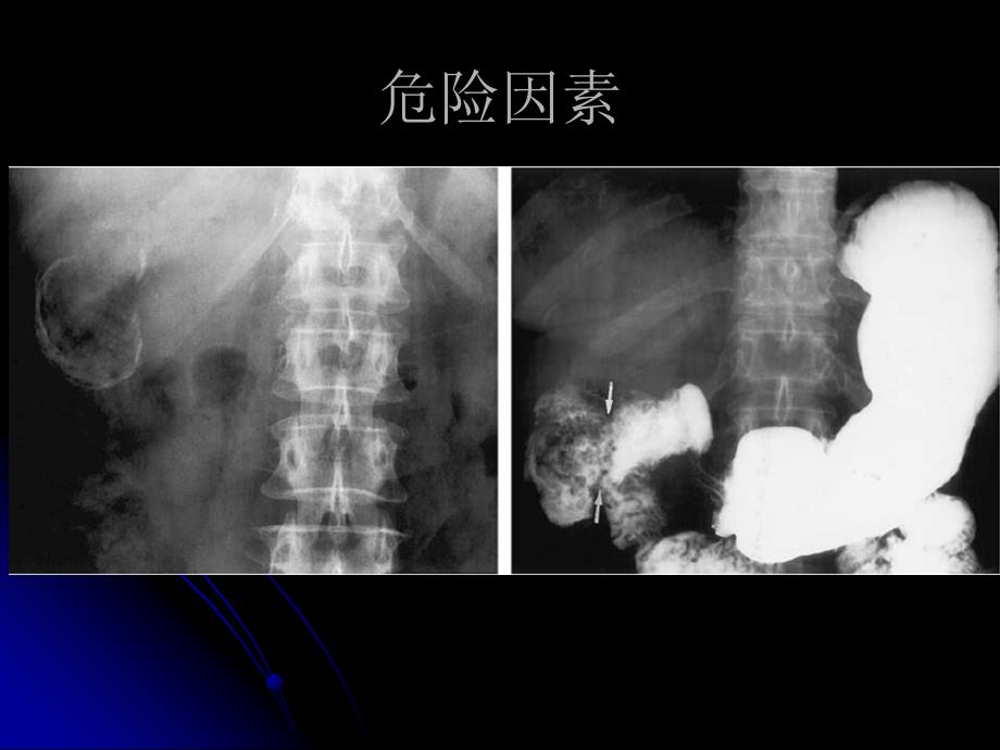 胆囊癌PPT课件_第3页