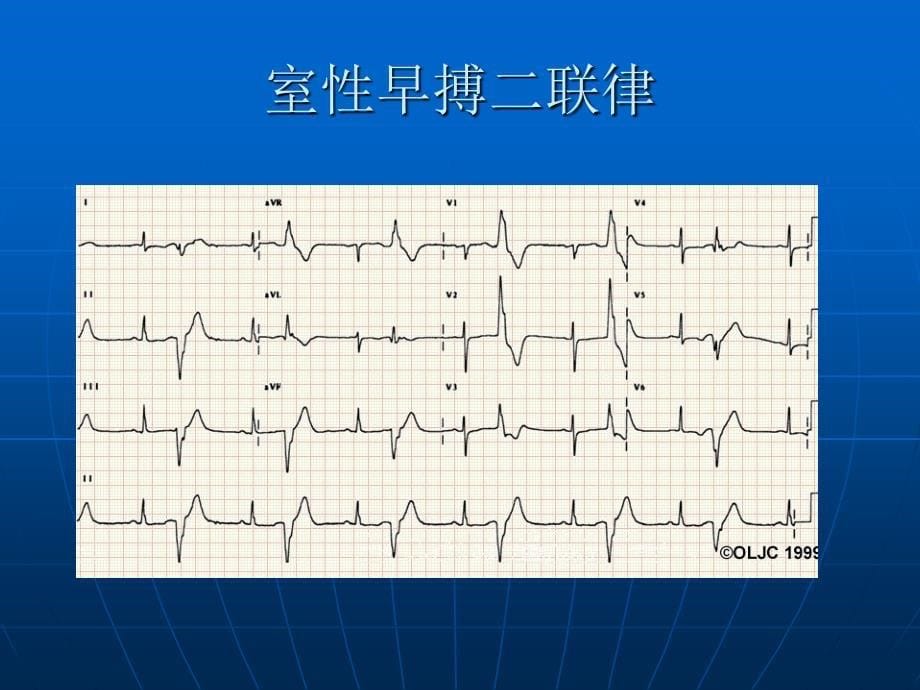 恶性心律失常的识别医学_第5页