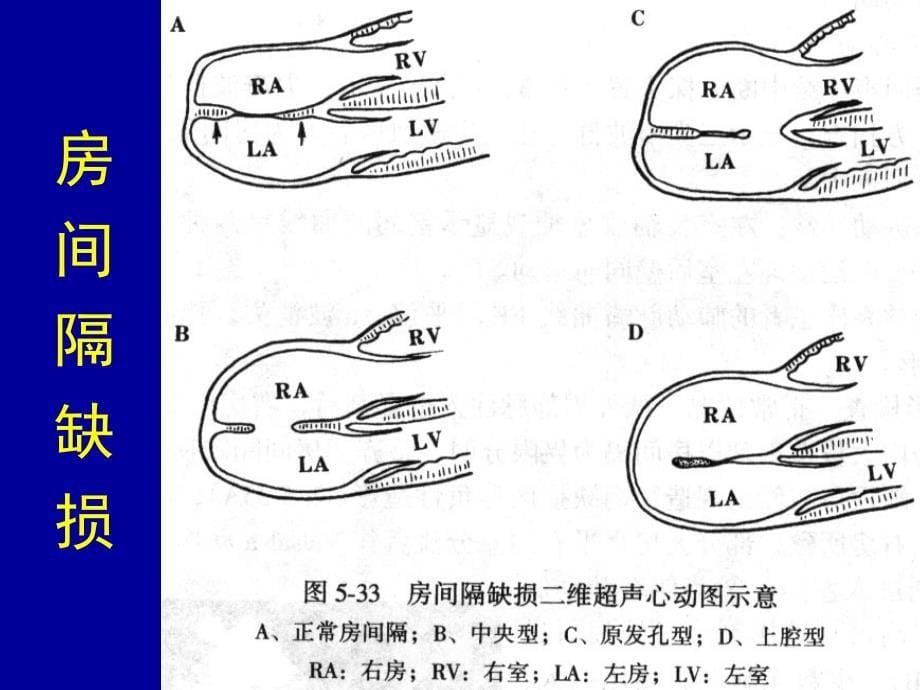 先天性心脏的超声诊断.ppt_第5页