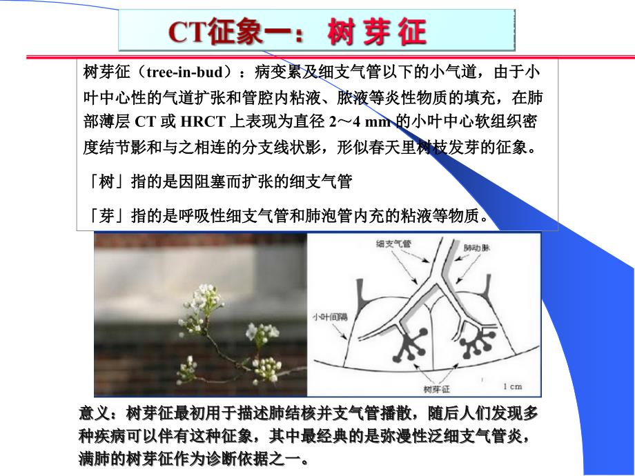 肺部CT十大征象诊断应用.ppt_第2页