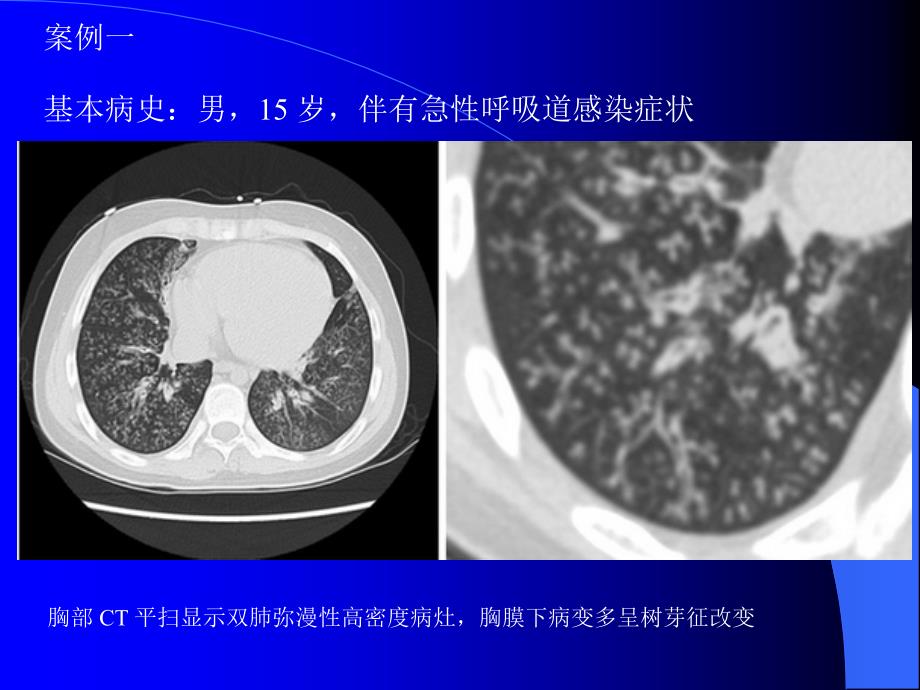 肺部CT十大征象诊断应用.ppt_第3页