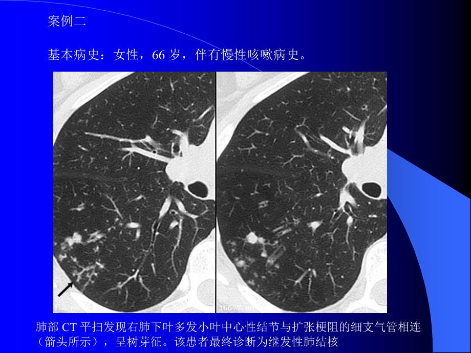 肺部CT十大征象诊断应用.ppt_第4页