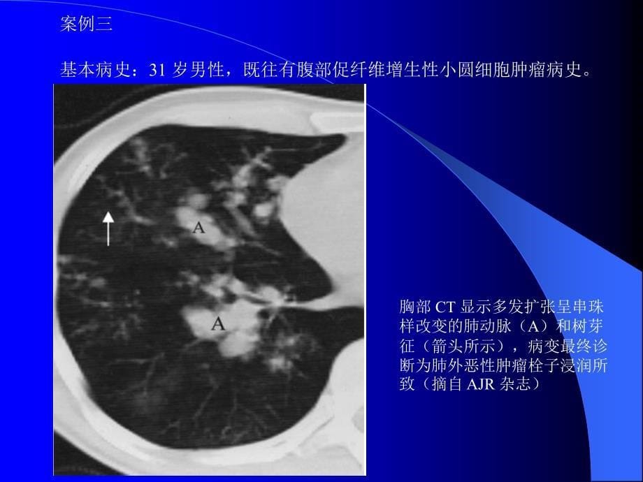 肺部CT十大征象诊断应用.ppt_第5页