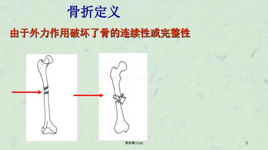 骨折概论czy课件_第3页