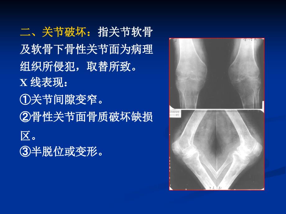 关节常见疾病的影像学诊断_第3页