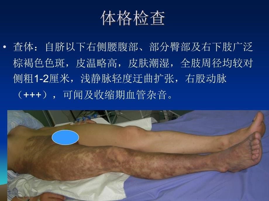 课件复杂腹主动脉瘤腔内治疗_第5页