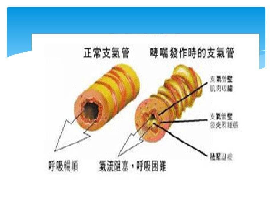 支气管哮喘治疗及护理.ppt_第5页