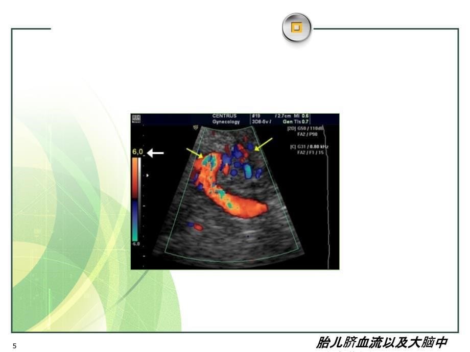 胎儿脐血流以及大脑中动脉监测课件_第5页