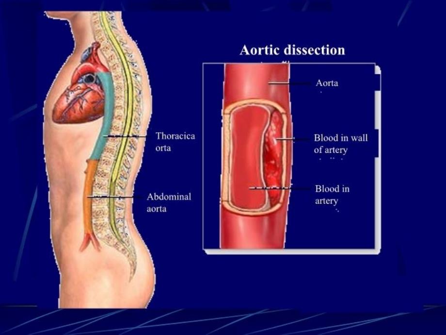 主动脉夹层本科生大课_第4页
