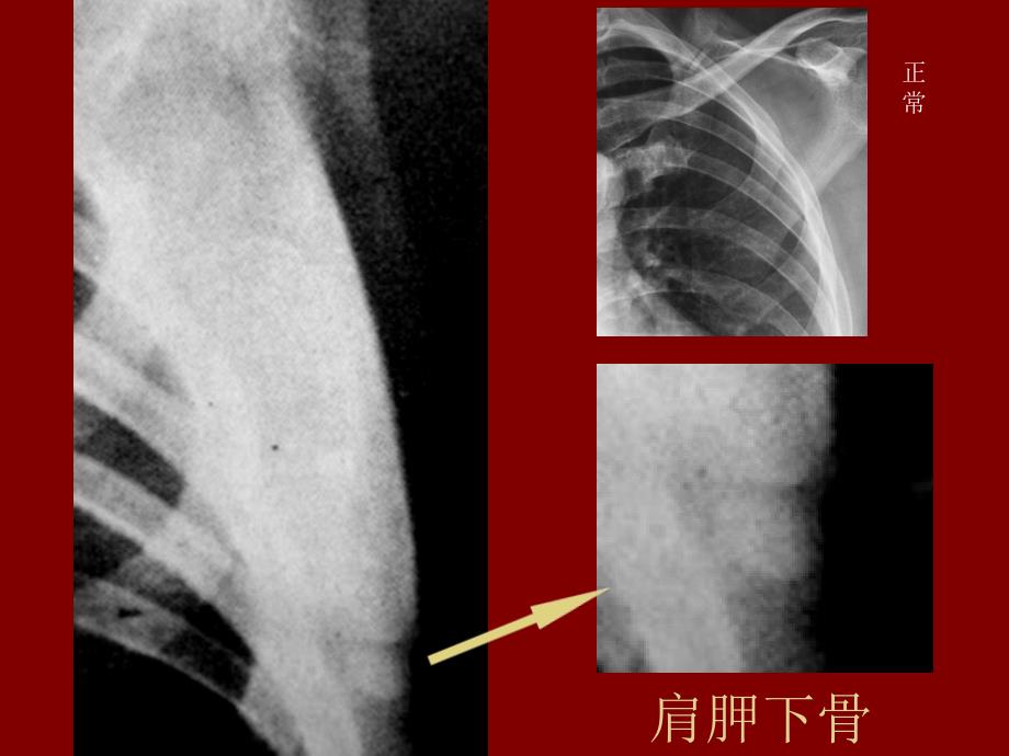 易误认为骨折阳的骨骺 张晓 ppt课件_第4页