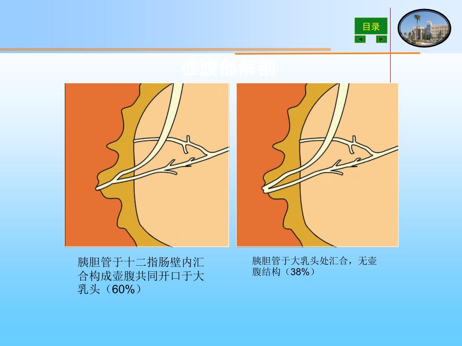 壶腹周围癌的影像诊断最新课件_第3页