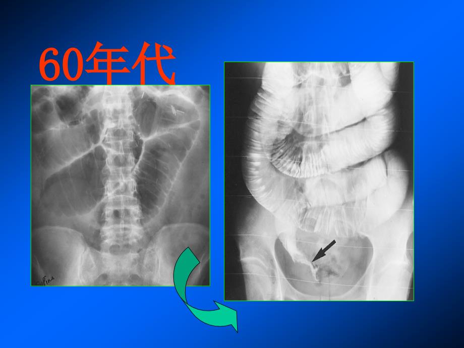 胃肠道影像检查技术的发展PPT课件_第3页