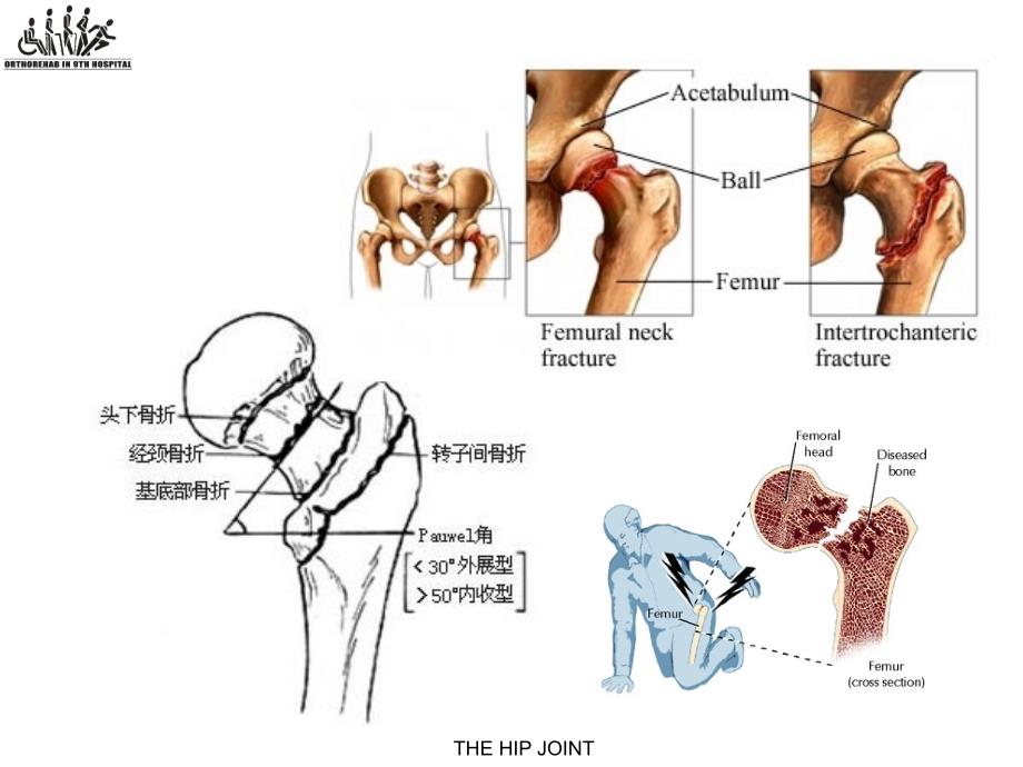 股骨颈骨折围手术期康复潘进社1教学课件_第3页