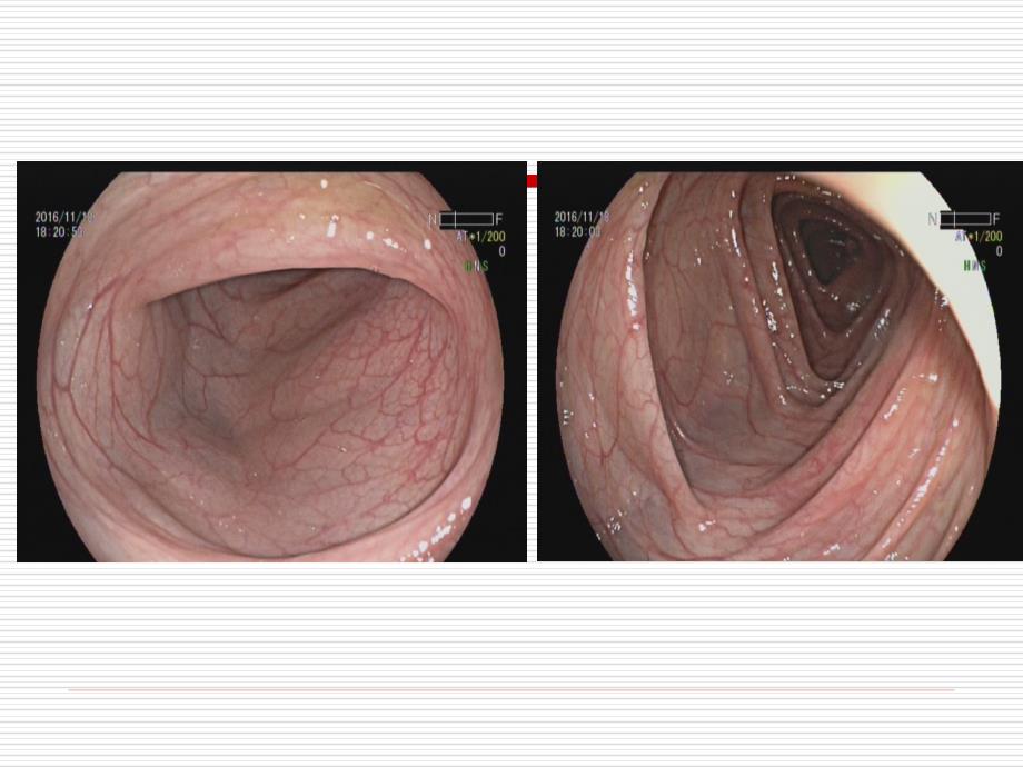 内科学课件：27_肠结核+结核性腹膜炎_第2页