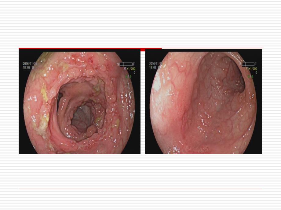 内科学课件：27_肠结核+结核性腹膜炎_第3页