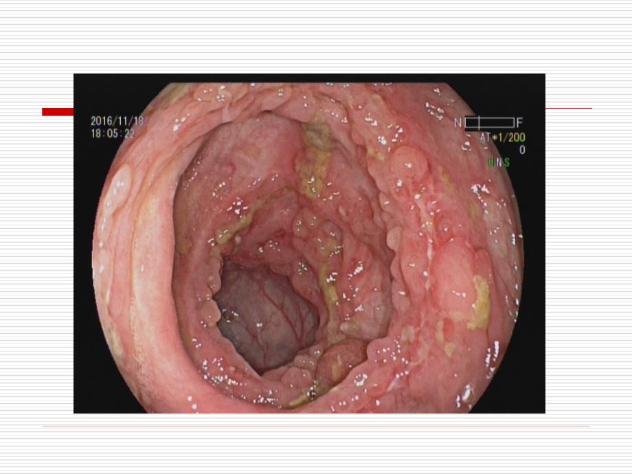 内科学课件：27_肠结核+结核性腹膜炎_第4页