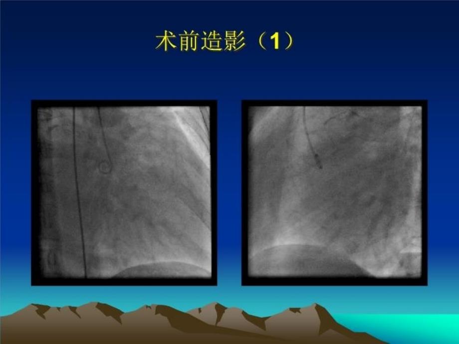 最新双封堵器介入治疗巨大左冠右房瘘1例胡海波PPT课件_第3页