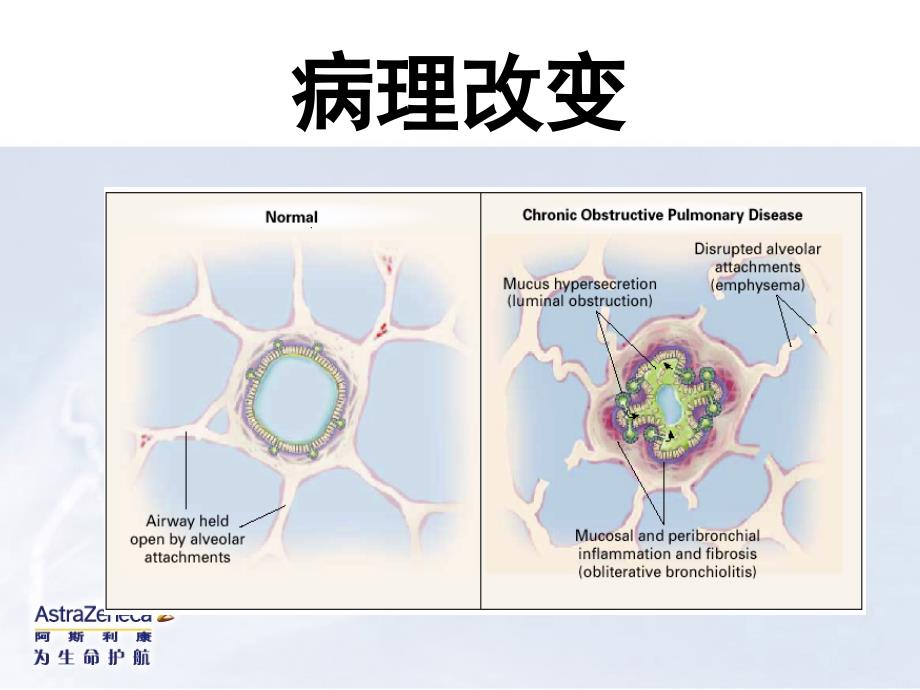 COPD的患者在围手术期的气道管理_第4页