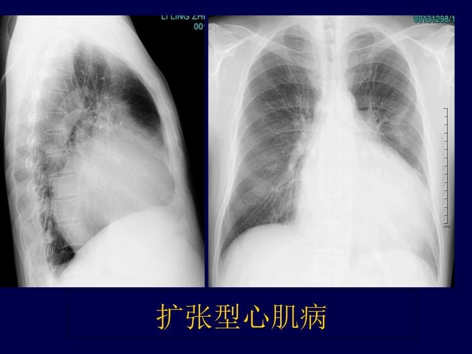 循环系统心包及主动脉夹层_第5页