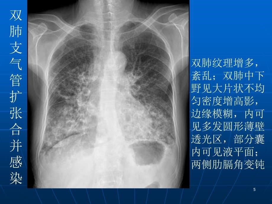 推荐精选肺部感染性疾病的影像观察与分析_第5页