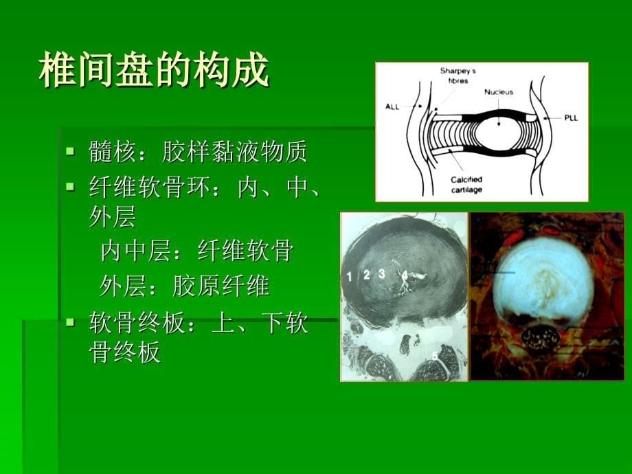 椎间盘突出的影像学诊断_第5页