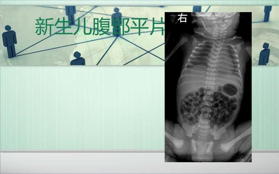 生儿腹部影像诊断课件_第5页