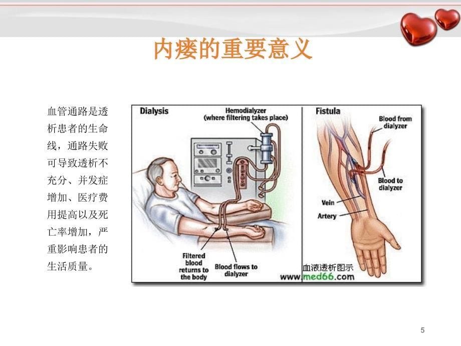 优质课件内瘘护理_第5页