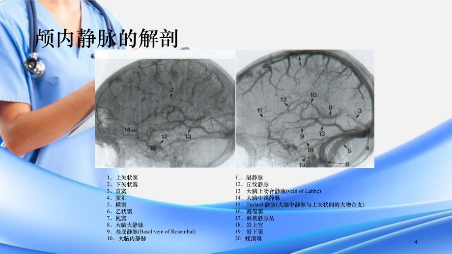 颅内静脉窦血栓形成课件精选干货_第4页