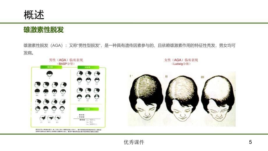 雄激素性脱发非药物治疗【医疗资料】_第5页