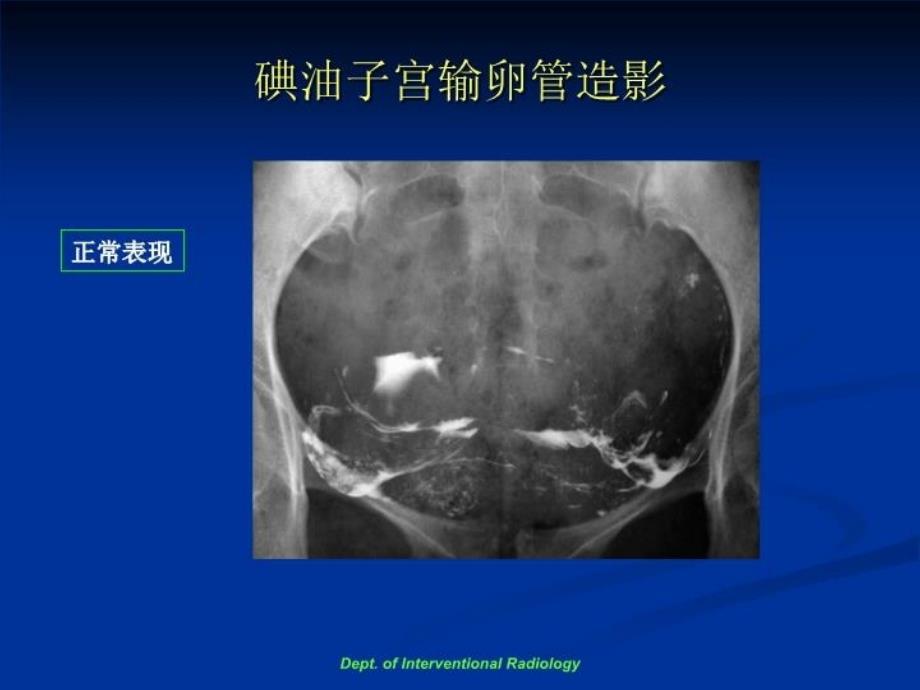 最新子宫输卵管造影和输卵管再通术PPT课件_第4页