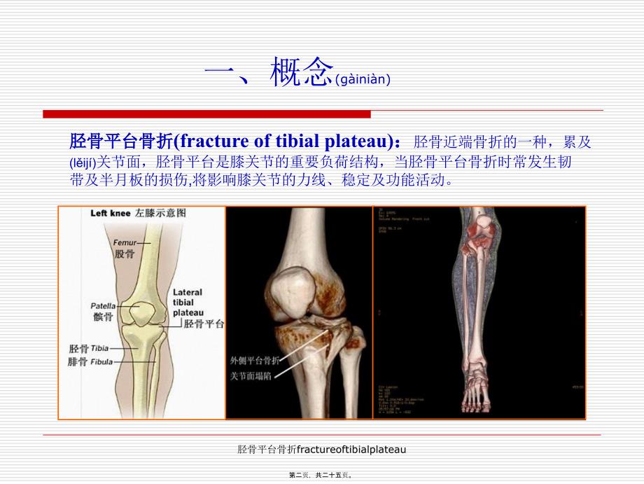 胫骨平台骨折fractureoftibialplateau课件_第2页