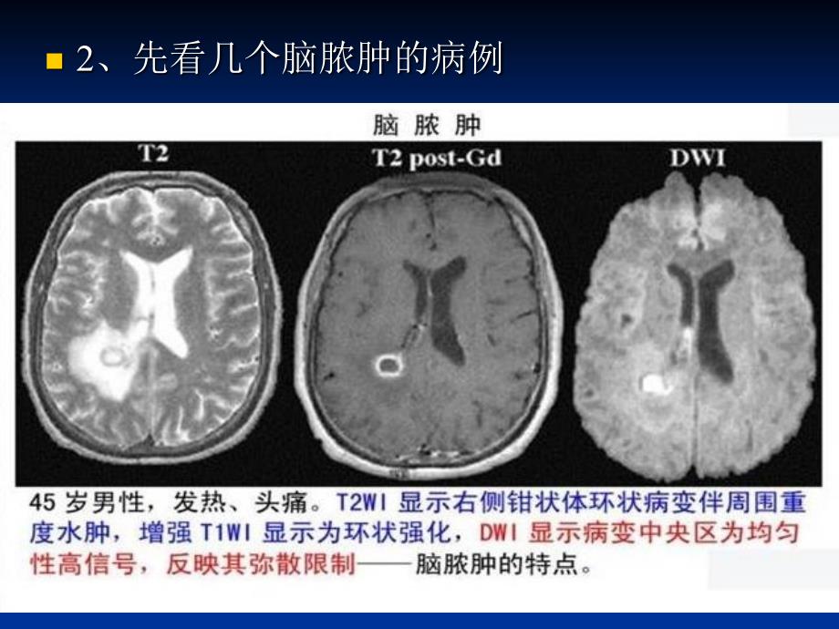 DWI在神经系统的临床应用课件_第3页