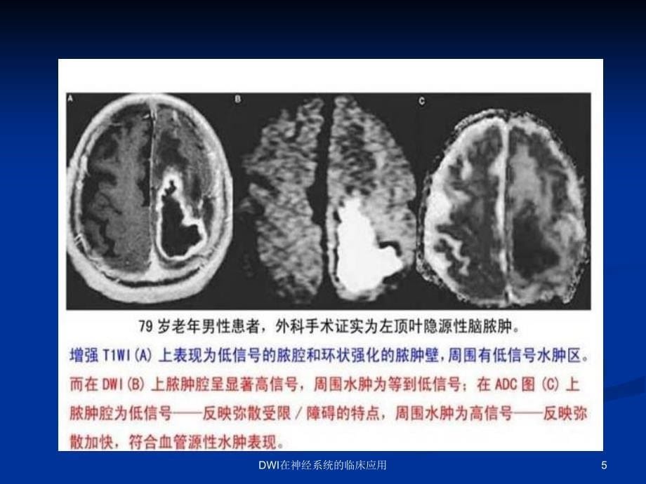 DWI在神经系统的临床应用课件_第5页